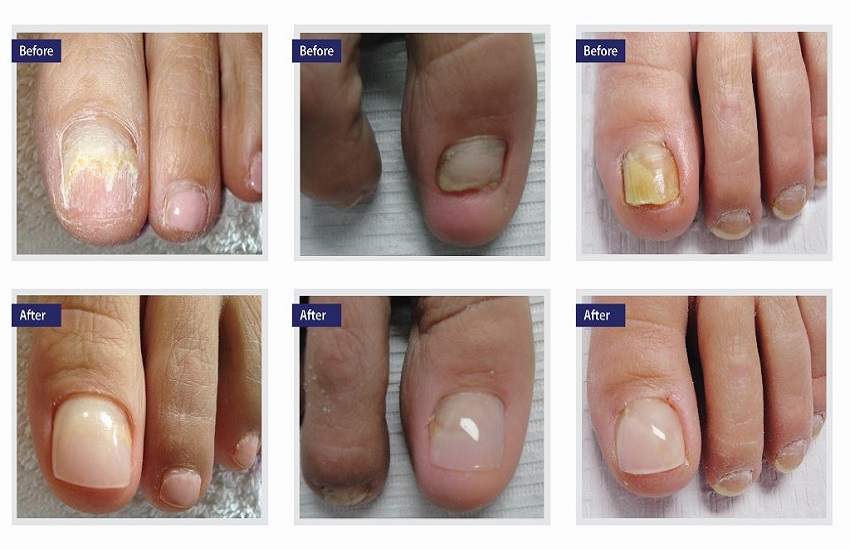 Stages of healing following toenail removal